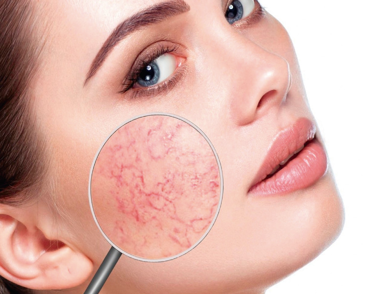 rosacea1